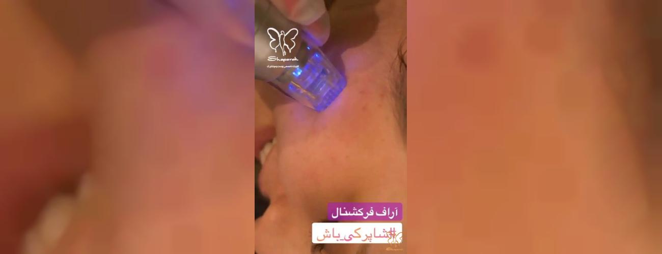  معجزه آراف فرکشنال برای پوست