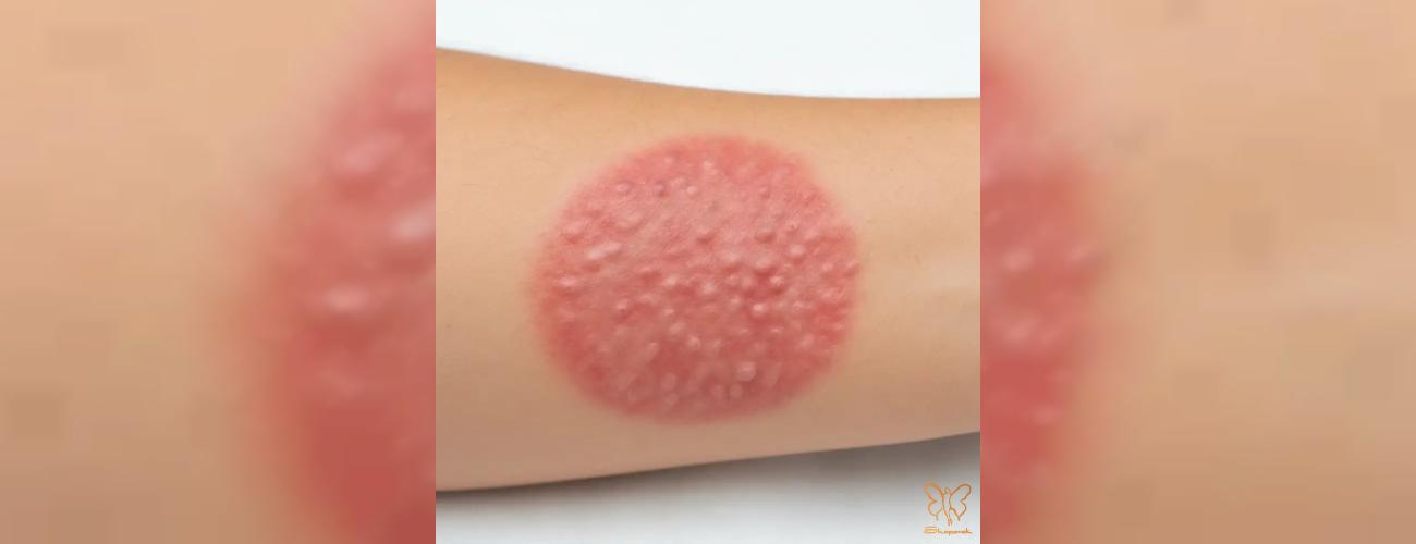 از تاول تا ترمیم؛ انواع سوختگی و بهترین روش‌های از بین بردن اسکار آن در کلینیک شاپرک طلایی مشهد