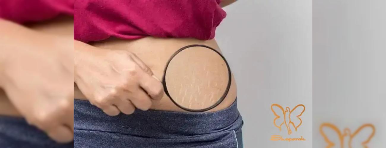 درمان ترک‌های پوستی: چرا استریا گاهی “درمان‌ناپذیر” به نظر می‌رسد؟ 