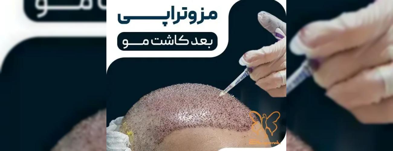 تقویت معجزه‌آسای موهای کاشته شده با مزوتراپی | از ریزش بعد از کاشت جلوگیری کنید