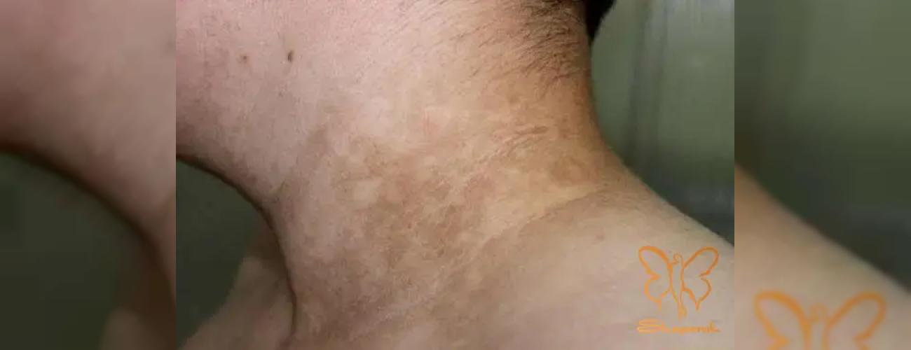 لک قهوه‌ای روی بدن: قارچ یا حساسیت؟ درمان قطعی در کلینیک شاپرک طلایی مشهد