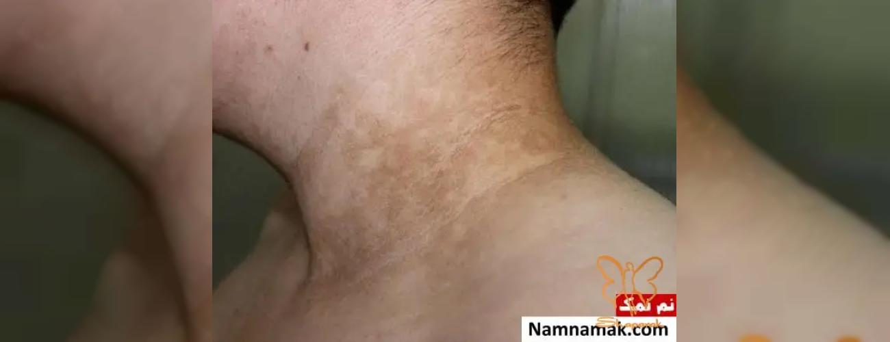 قارچ پوستی بعد از استخر: راهنمای کامل پیشگیری و درمان قطعی در مشهد