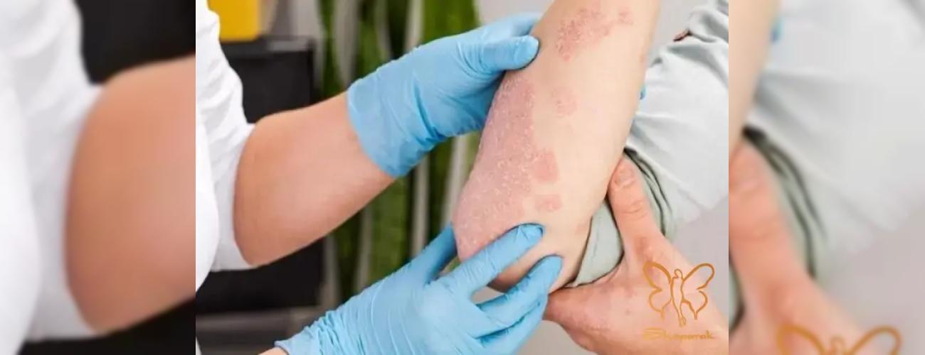 پسوریازیس! یک بیماری مزمن غیرمسری: تمام آنچه باید قبل از خدمات لیزر موهای زائد بدانید