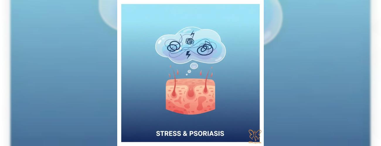 ارتباط استرس و پسوریازیس: چگونه استرس پوست شما را بدتر می‌کند؟