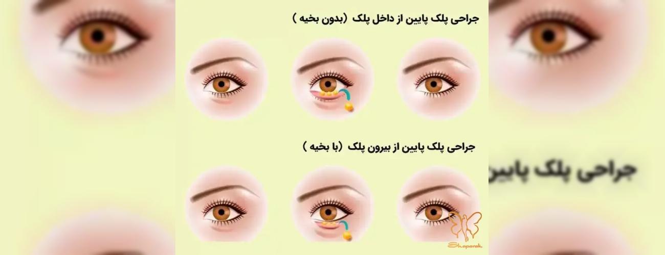 بلفاروپلاستی ترانس کونژانکتیوال در مشهد: رفع دائمی پف زیر چشم بدون بخیه در کلینیک شاپرک