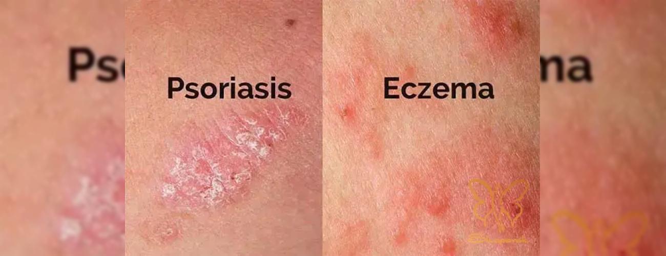  لیزر موهای زائد برای افراد دارای پسوریازیس و اگزما در مشهد