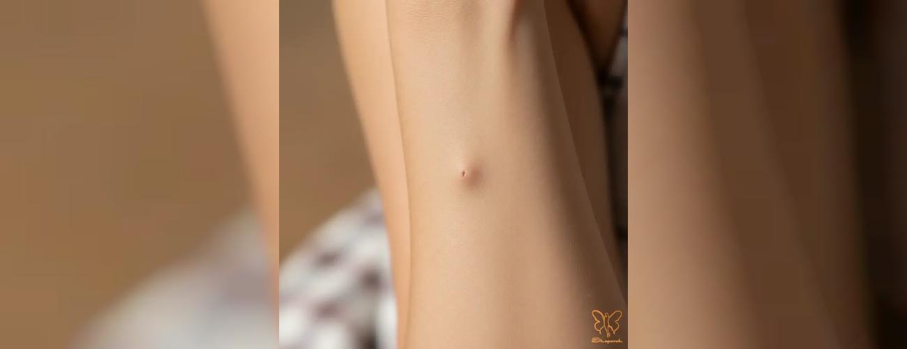 درمان قطعی کیست مویی در مشهد: پایان درد با جراحی نوین در کلینیک شاپرک طلایی