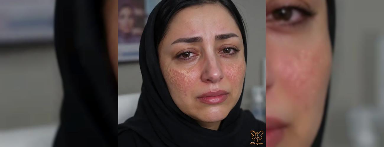 عوارض کرم پودر دائم (BB Glow) که شما را پشیمان می‌کند | راهکار علمی در مشهد 