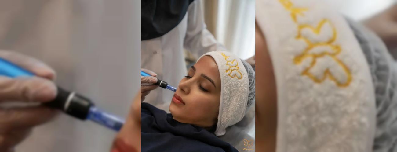 میکرونیدلینگ و مزونیدلینگ حرفه‌ای در مشهد رفع چین و چروک و لک‌های پوستی