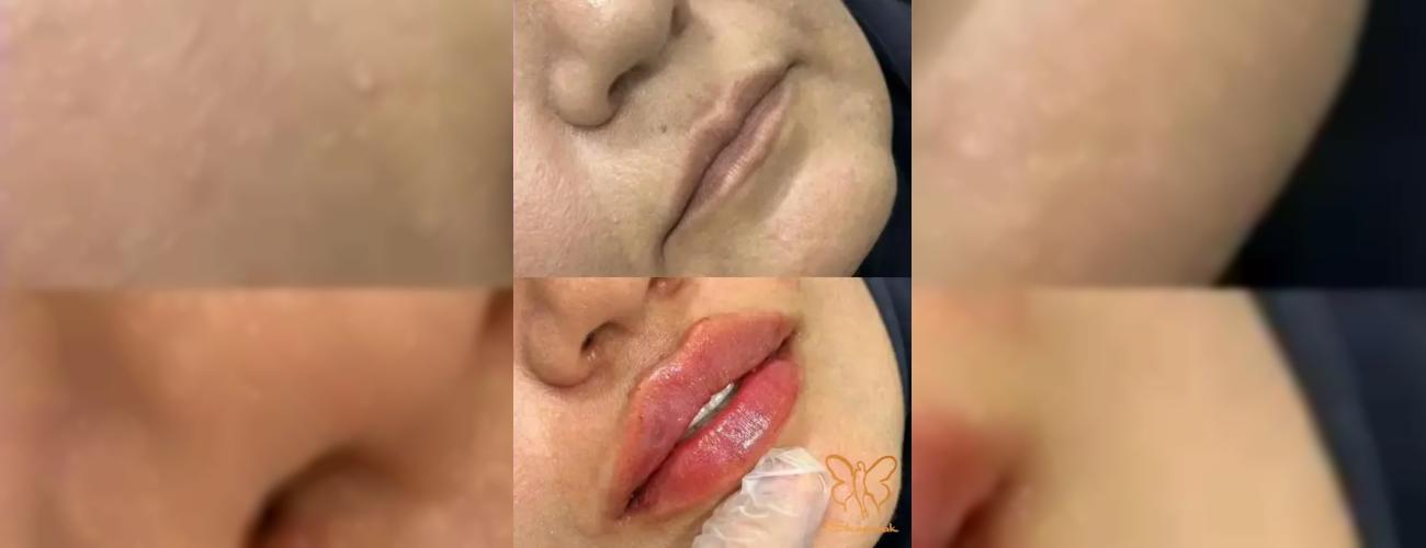 قبل و بعد از فیلر لب چه کار هایی را نباید انجام داد؟ نکات کلیدی در کلینیک تخصصی پوست و مو شاپرک طلایی