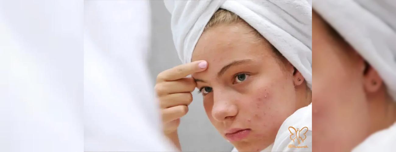 لیزر فوتونا برای آکنه و جوش فعال چگونه عمل می‌کند؟ 
