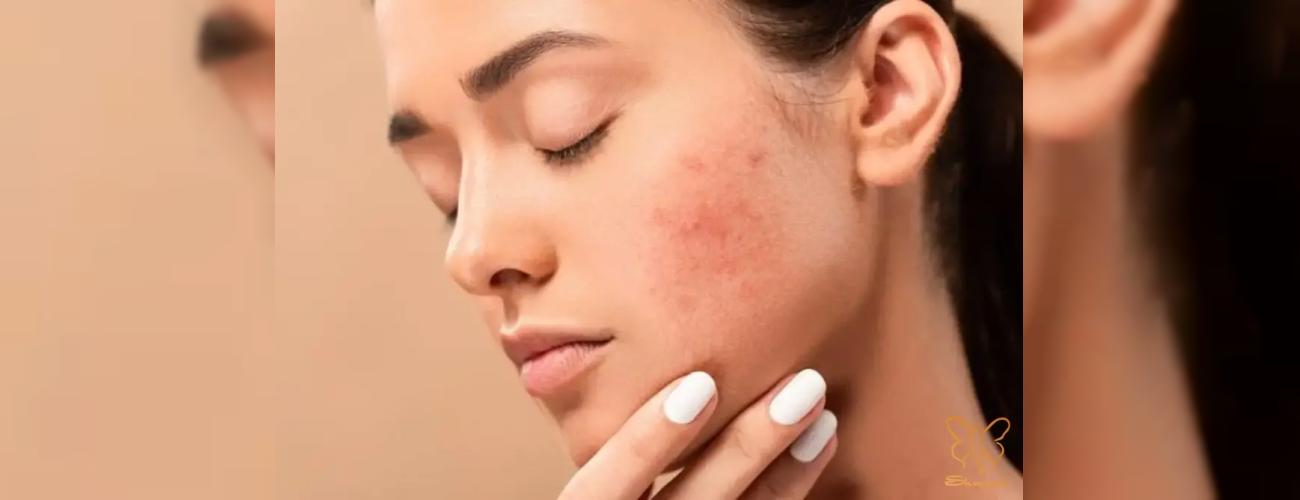 کمدون! رهایی از جوش های آزار دهنده در کلینیک شاپرک طلایی مشهد