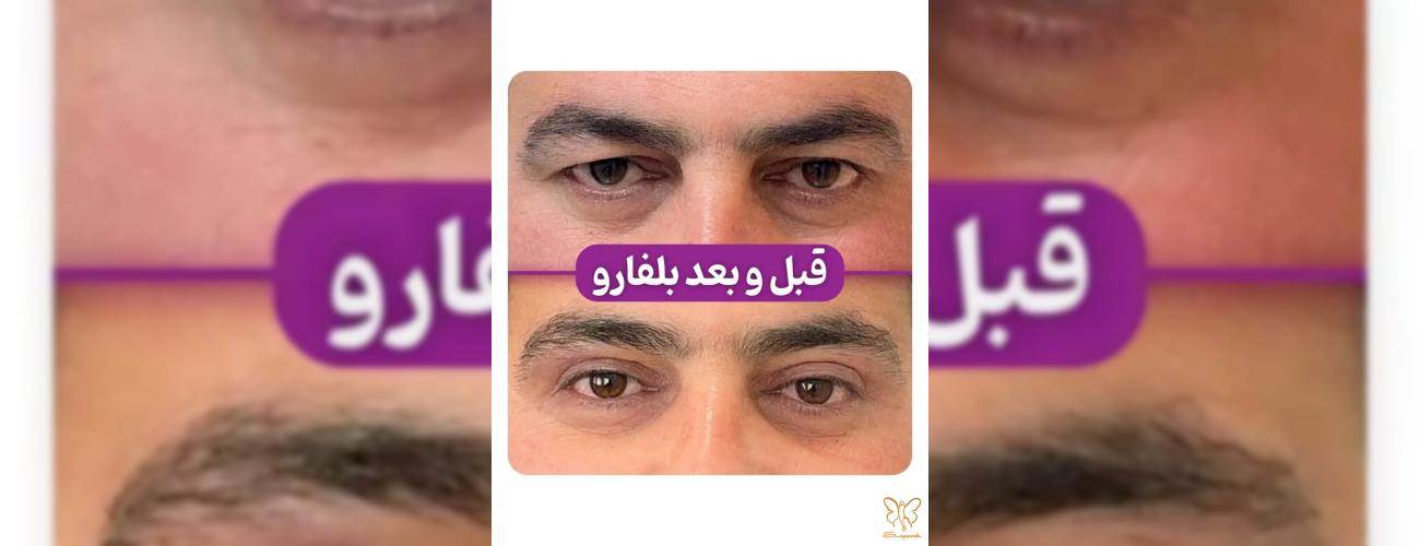 بلفاروپلاستی تخصصی در مشهد رفع افتادگی پلک و پف چشم با کلینیک شاپرک طلایی