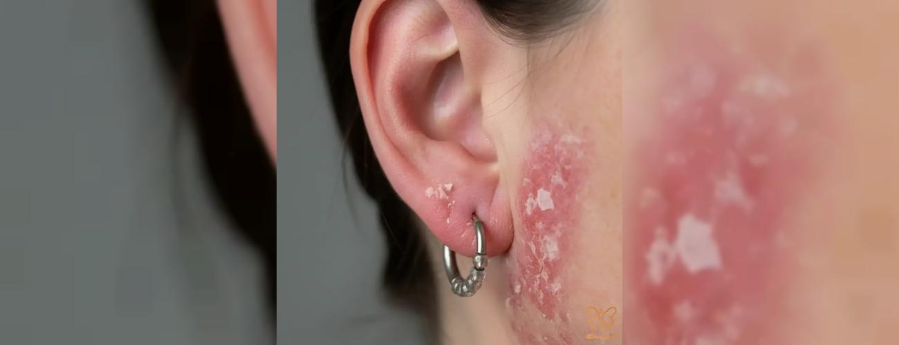 آیا گوشواره‌های بدلی، عامل ایجاد اگزما در کل بدن هستند؟