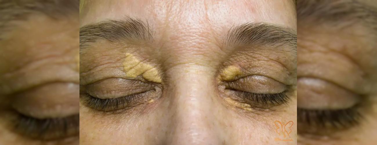 خداحافظی همیشگی با لکه‌های زرد پشت پلک؛ روش‌های نوین رفع گزانتلاسما در مشهد