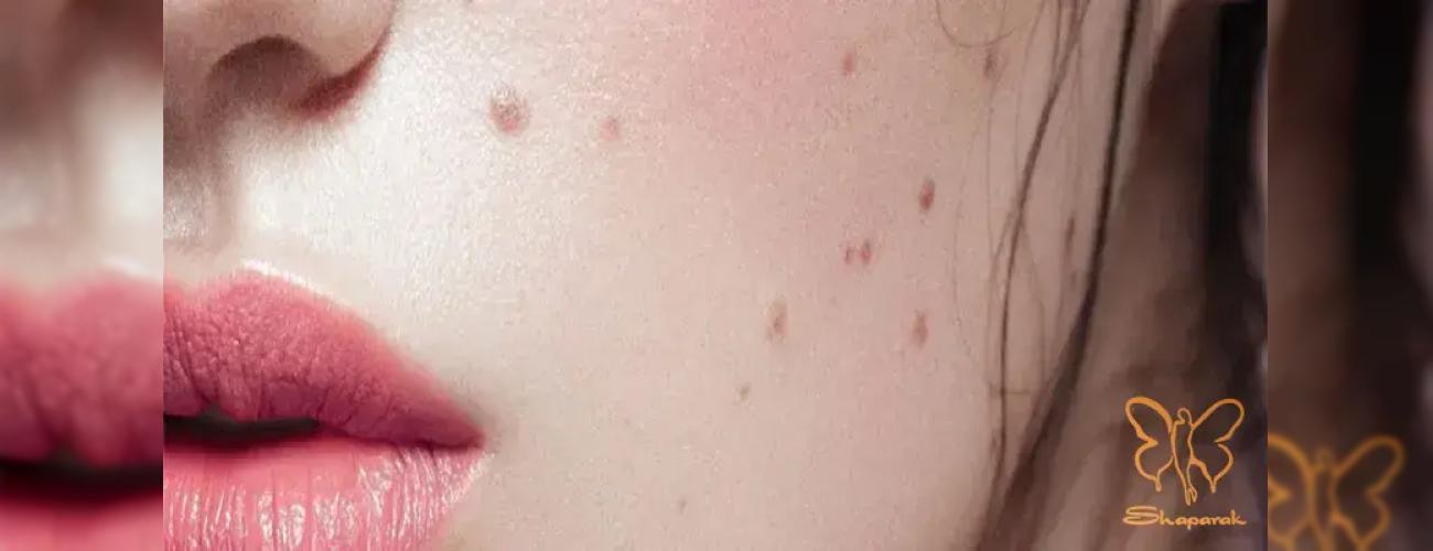 راز داشتن پوستی یکدست: صفر تا صد شناخت و درمان قطعی خال و زگیل