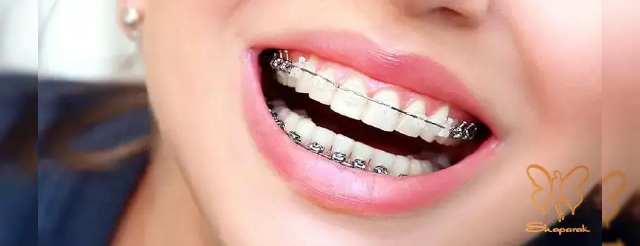 تزریق ژل لب با وجود ارتودنسی: تمام نکات و مراقبت‌هایی که باید بدانید با شاپرک طلایی 