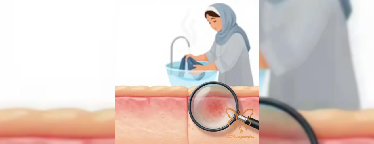 از راش‌های پوستی تا ریزش مو؛ همه چیز درباره عوارض و درمان بیماری تیفوس