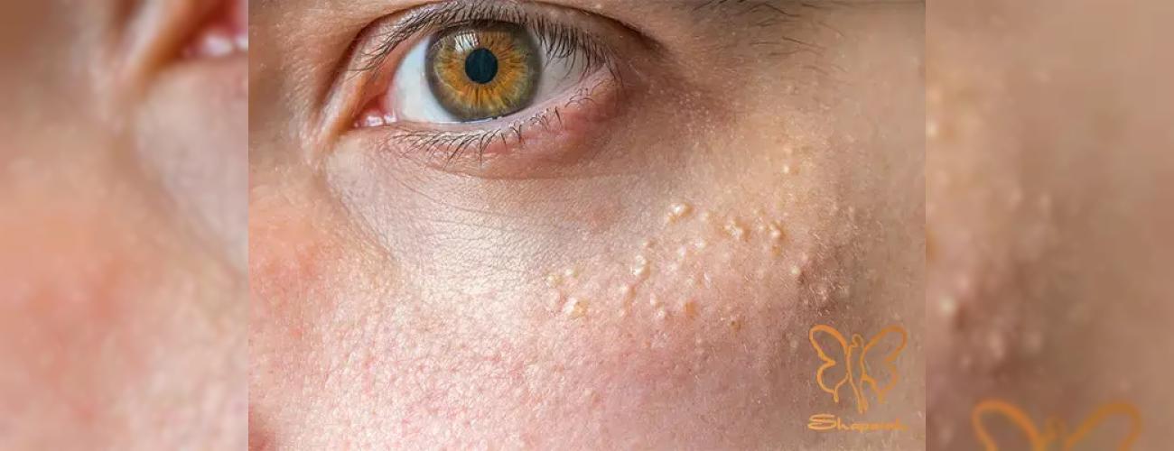تفاوت میلیا و جوش سرسفید چیست؟ بهترین روش‌های درمانی از لیزر تا لایه‌برداری در مشهد