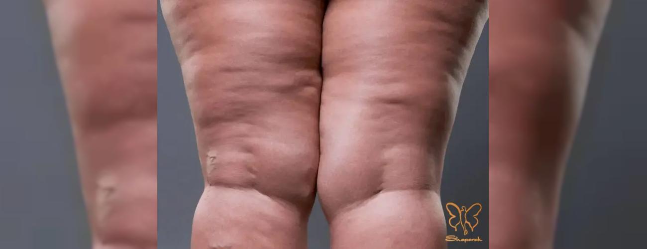 اسکراب قهوه یا لیزر فوتونا؟ کدام راه برای رفع سلولیت ران در مشهد موثرتر است؟