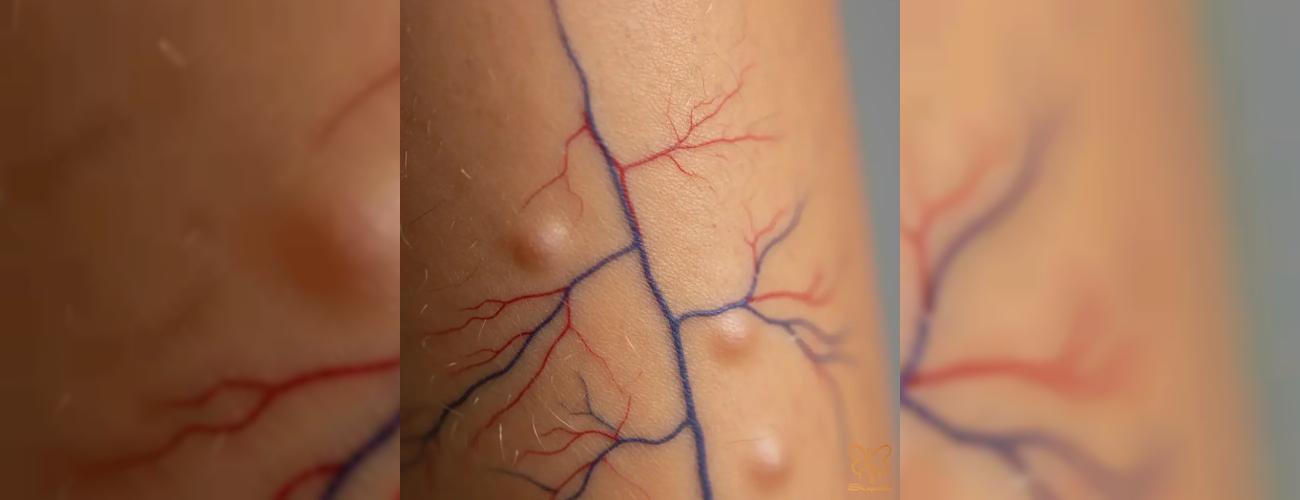 فوتونا فرکشنال آکنه یا عروقی؟ تفاوت‌ها و انتخاب هوشمندانه در کلینیک شاپرک طلایی مشهد