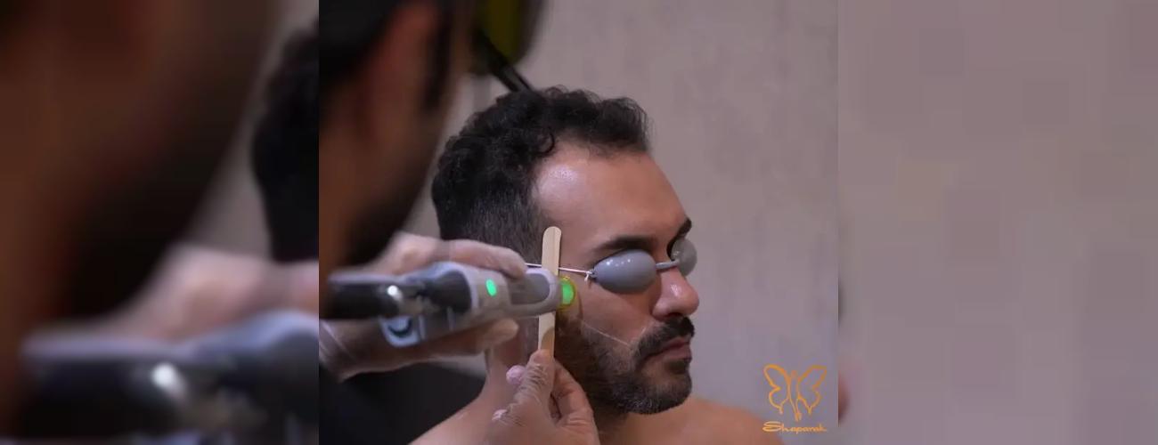 تفاوت لیزر مو زائد در آقایان و خانم ها در مشهد