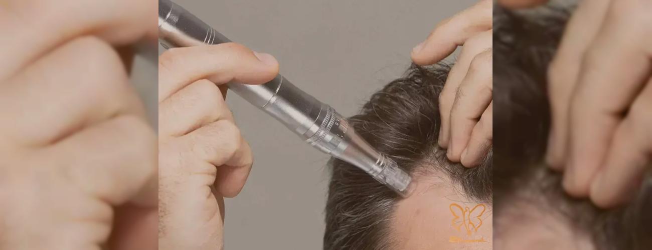 مزونیدلینگ مو در مشهد: معجزه فیوژن و رویتاکر برای درمان ریزش مو