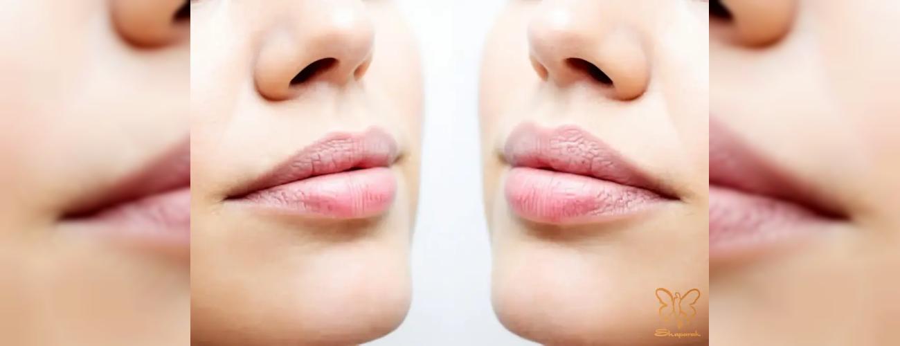 عوارض بوتاکس لیفت لب: آنچه در مشهد باید بدانید | کلینیک شاپرک طلایی