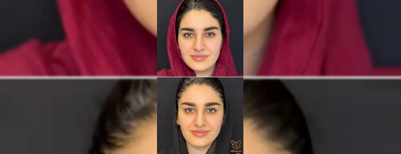 لیفت ابرو بدون جراحی در کمتر از 10 دقیقه در مشهد