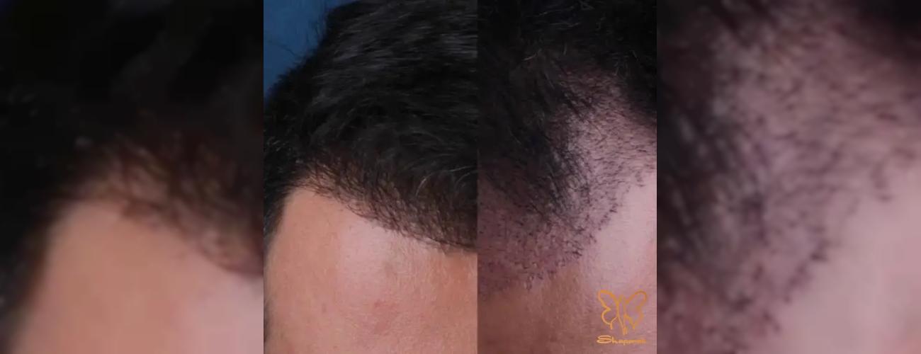 کاشت مو در کلینیک شاپرک طلایی مشهد راهکاری دائمی برای درمان ریزش مو