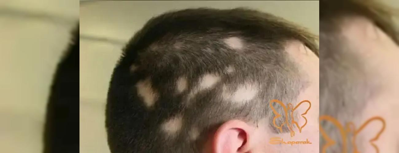 کمبود این ویتامین پنهان، دلیل اصلی ریزش موی سکه‌ای شماست