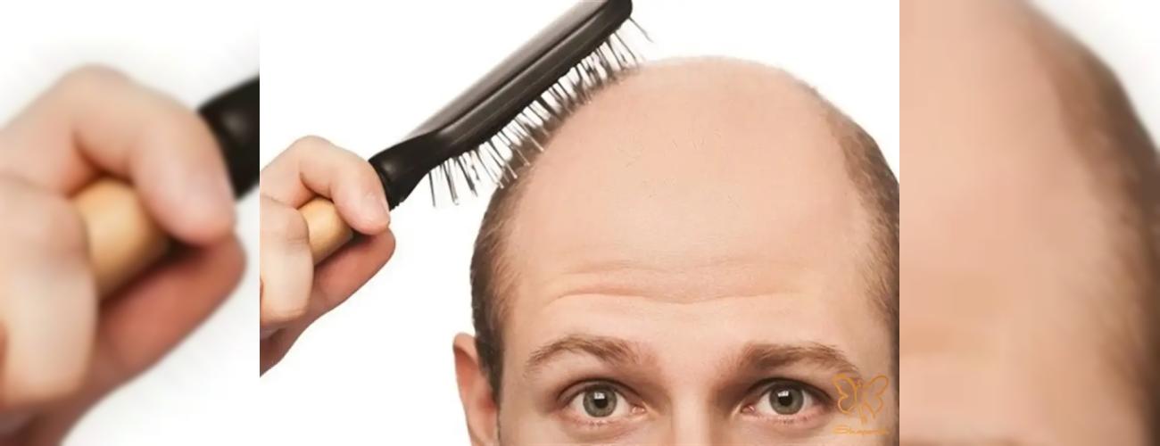 هر ریزش مویی درمان اختصاصی خودش را دارد! | راهنمای جامع PRGF، مزوتراپی و لیزر مو در مشهد