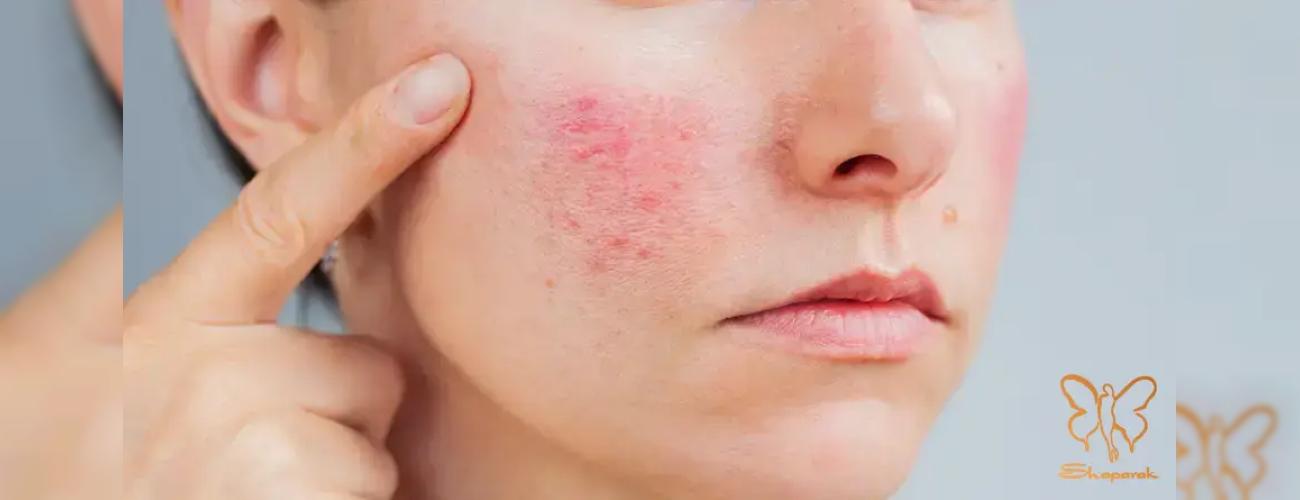 ممنوعیت های خدمات زیبایی برای پوست حساس و اگزمایی! کلینک شاپرک مشهد 