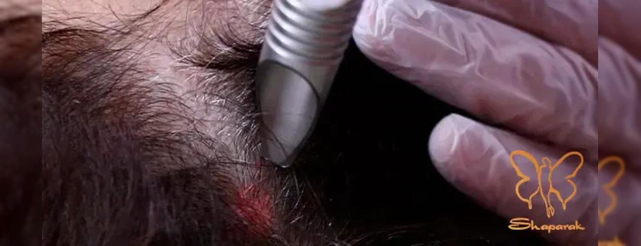 توقف ریزش و رویش مجدد مو با فوتونا میکرودرلینگ سر در کلینیک شاپرک مشهد