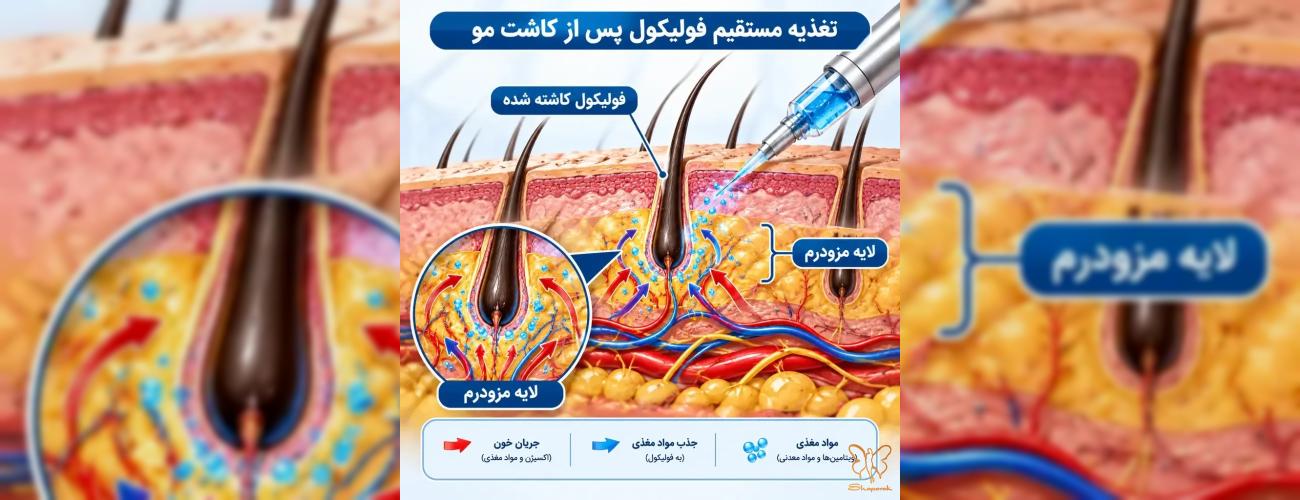 بهترین زمان شروع مزوتراپی و PRP بعد از کاشت مو (جدول زمانی طلایی)
