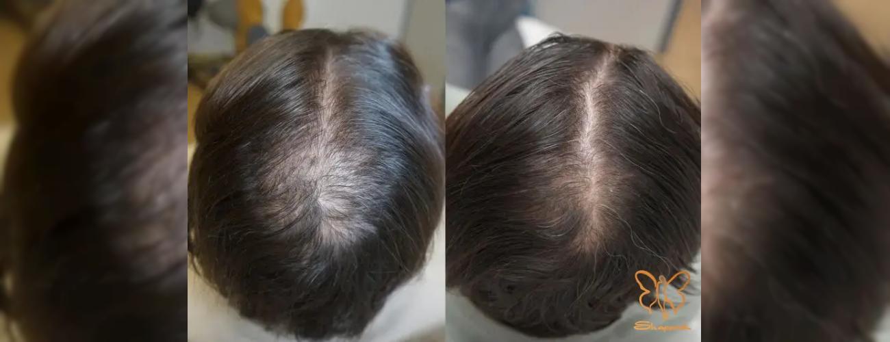 هیرفیلر آلپاژینا + پی آر پی PRP: جدیدترین متد رشد مجدد مو در مشهد