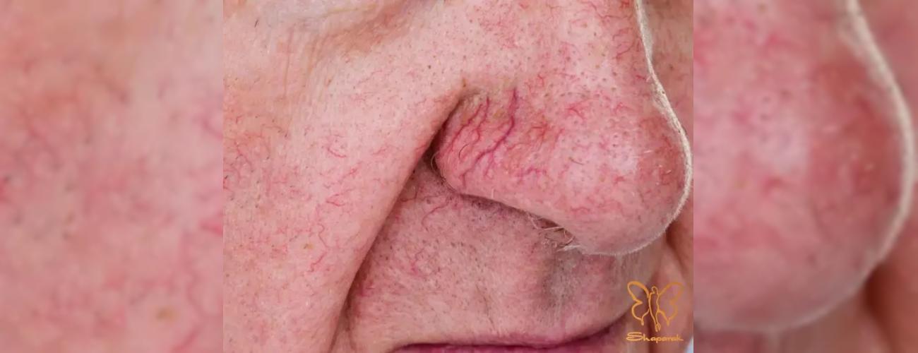 درمان قطعی رگ‌های عنکبوتی بینی در مشهد | خداحافظی با قرمزی پوست در یک جلسه