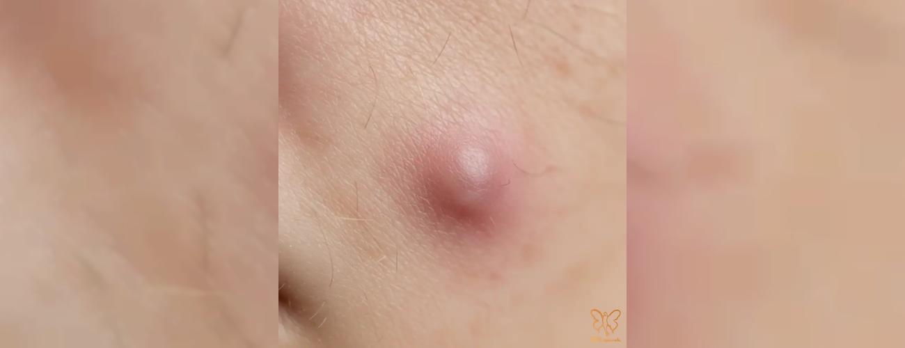 نجات پوست از جوش زیر پوستی در مشهد: فرمول درمانی پیشرفته کلینیک شاپرک که پوست شما را احیا می‌کند