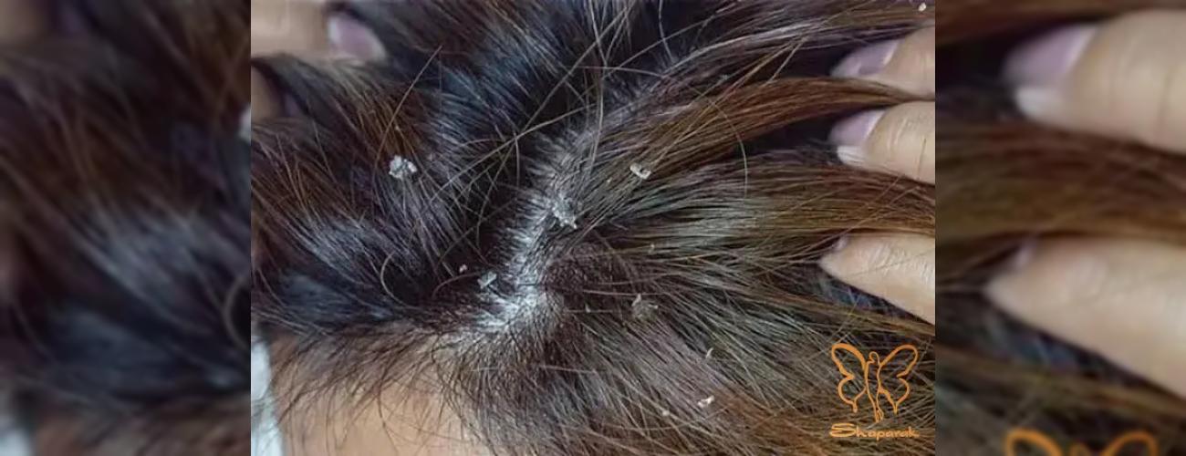 اسکالپ تراپی کف سر چیست؟ + مراحل پاکسازی عمیق مو در کلینیک شاپرک طلایی مشهد