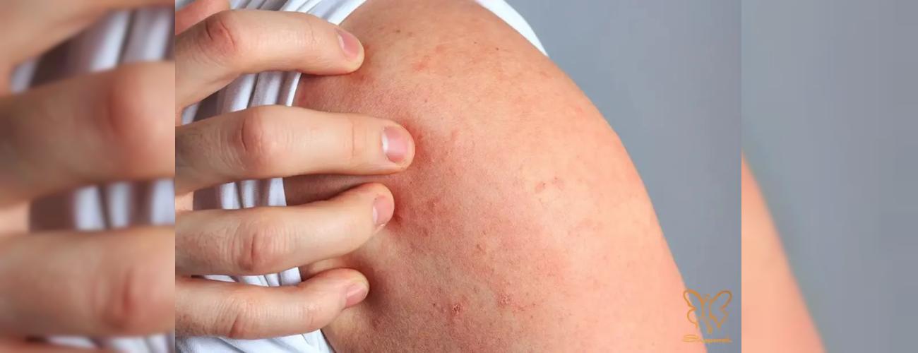 راش پوستی (Rash) چیست؟ انجام خدمات ایمن زیبایی در کلینیک شاپرک مشهد