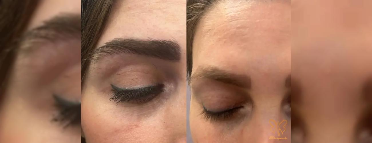 مراقبت‌های حیاتی بعد از کاشت ابرو در کلینیک شاپرک طلایی