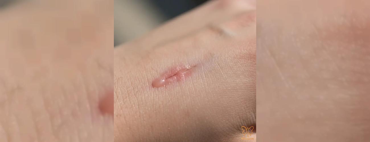 خونابه بعد از بخیه جراحی: طبیعی است یا خطرناک؟ | راهنمای کامل کلینیک شاپرک طلایی مشهد