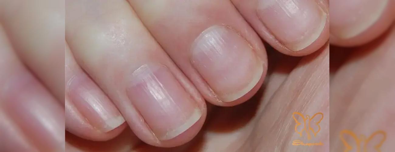 کلینیک شاپرک مشهد: از تشخیص تا درمان ناخن‌ های کبریتی