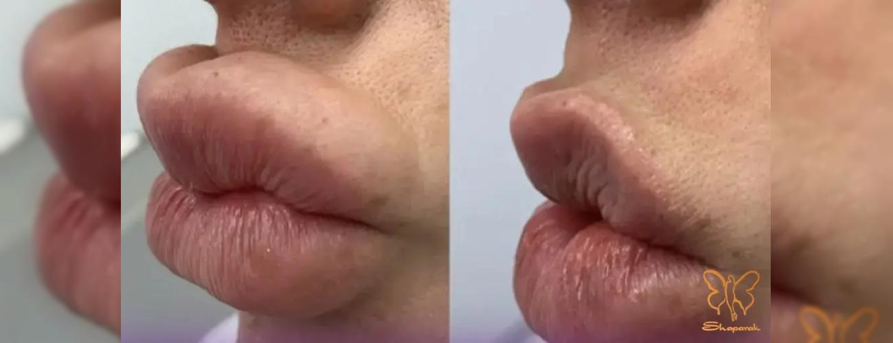 چرا لب‌های روسی بعد از مدتی “اردکی” می‌شوند؟ پیشگیری از جمع شدن ژل در پشت لب 