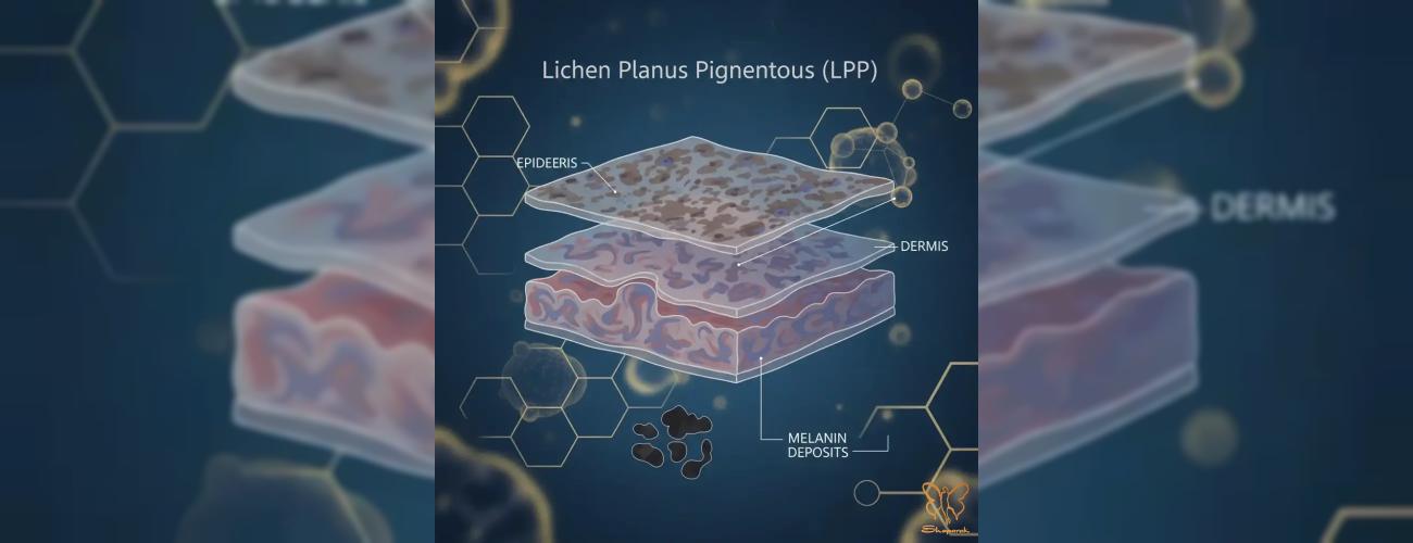 راهنمای کامل لیکن پلان پیلاریس (LPP): از علائم تا درمان و خدمات زیبایی مجاز