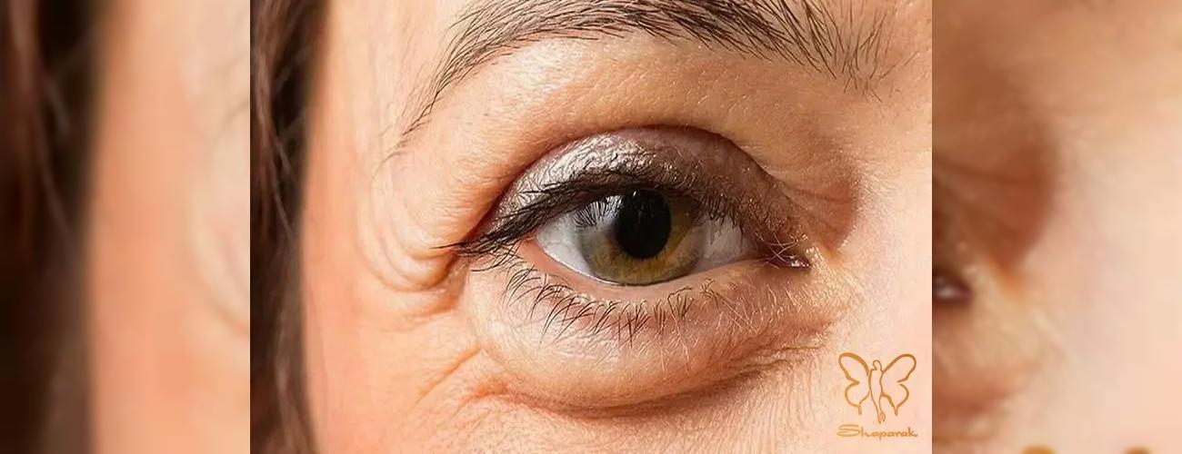 پف و تیرگی زیر چشم: از علت تا درمان های رضایت بخش در کلینیک شاپرک طلایی