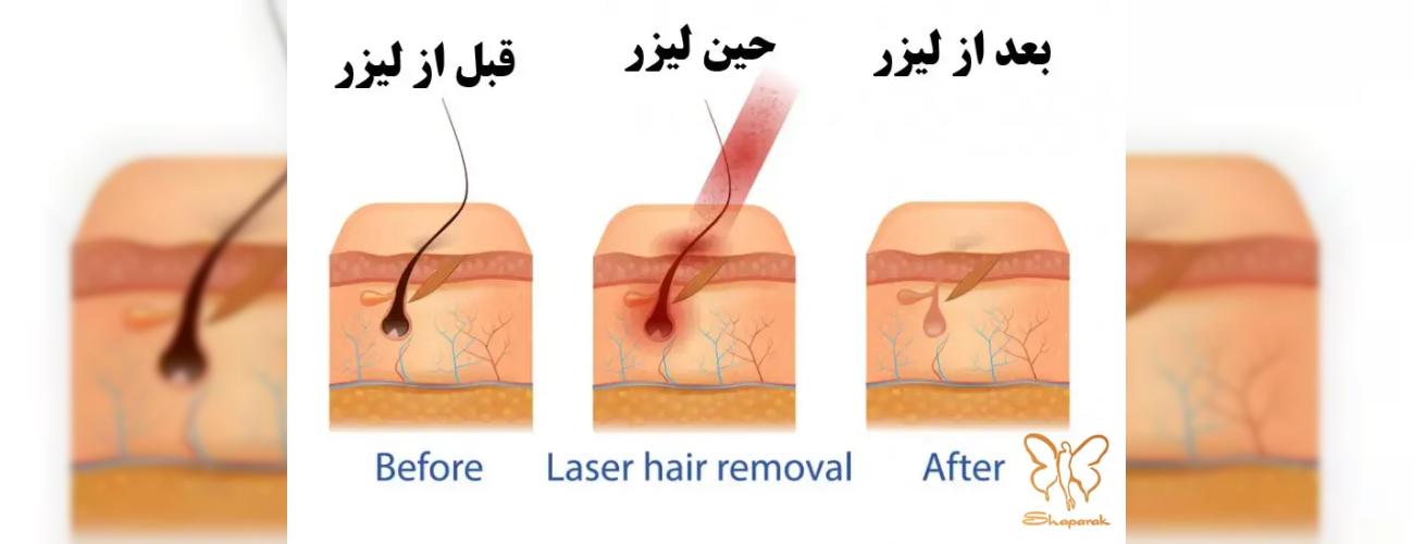 لیزر مو‌های زائد در مشهد برای چه کسانی ضرر دارد؟