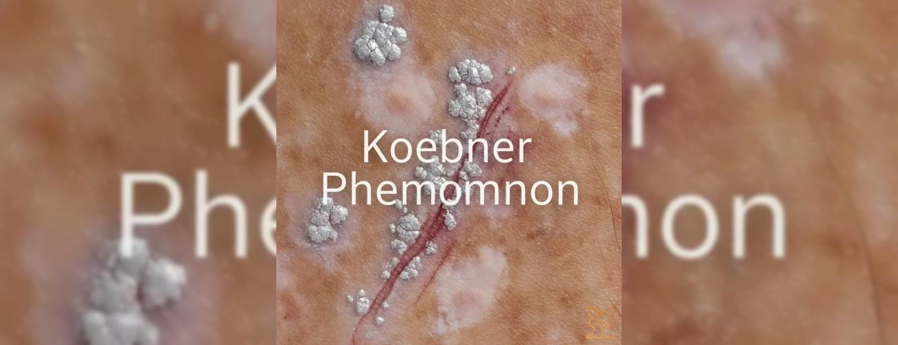 پدیده کوبنر (Koebner): چرا پوست شما به جای درمان، واکنش می‌دهد؟