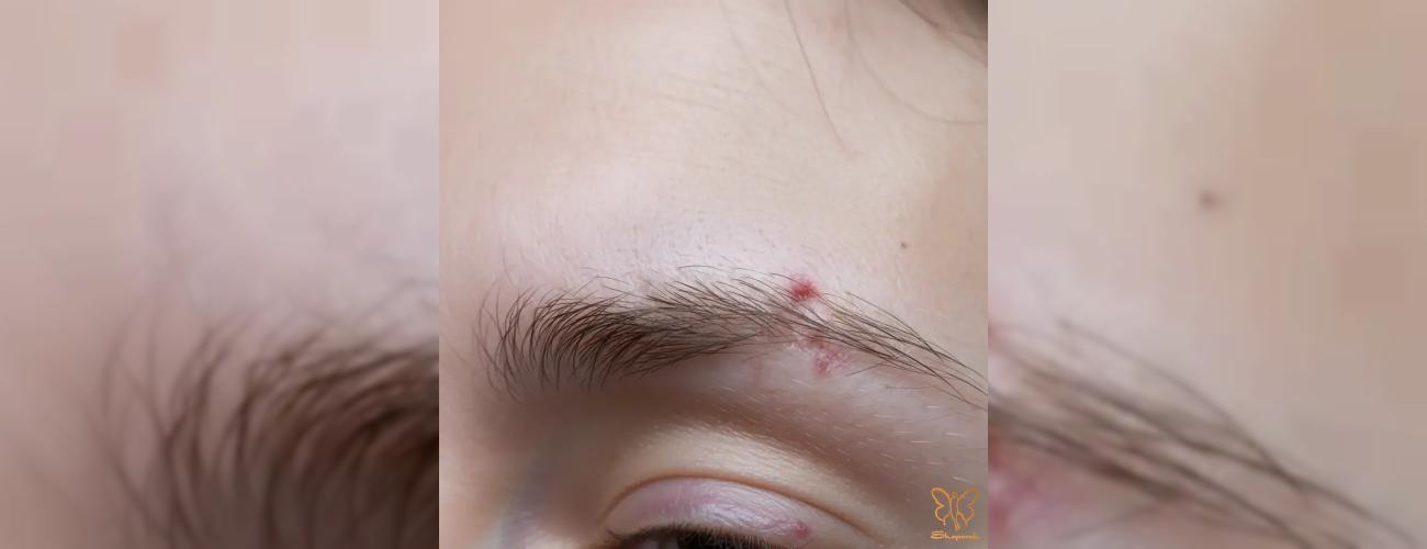 آیا ریزش ابروهایتان هشدار تیروئید کم‌کار است؟ روش های درمان در مشهد