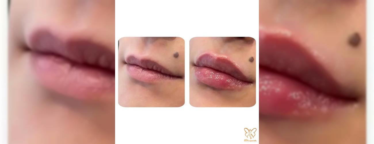 چند سی سی ژل لب برای شما کافیست؟ | راهنمای کامل کلینیک شاپرک طلایی 